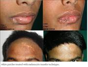 Before After Pictures,Delhi,white patches, leukoderma